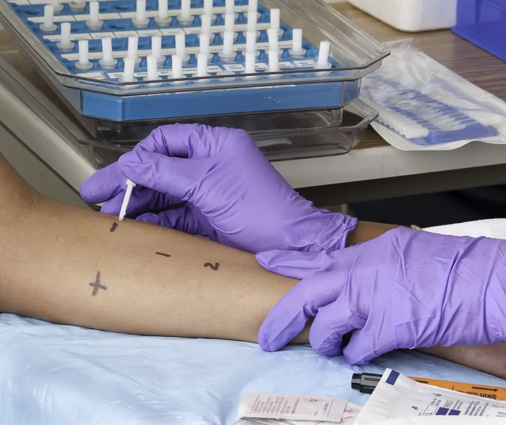 Test cutanat de înțepătură (prick test) pentru alergii — pacient cu extracte alergenice aplicate pe antebraț