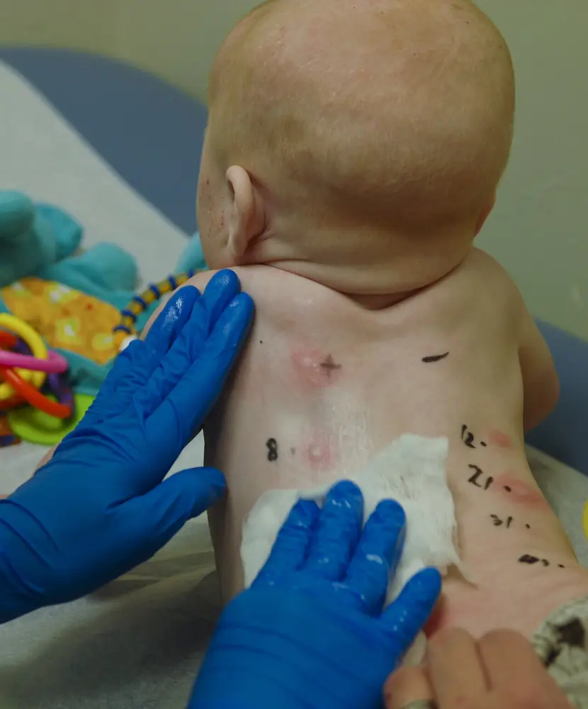 Test de alergie la un copil — testare cutanată pentru diagnosticul alergiei la copii